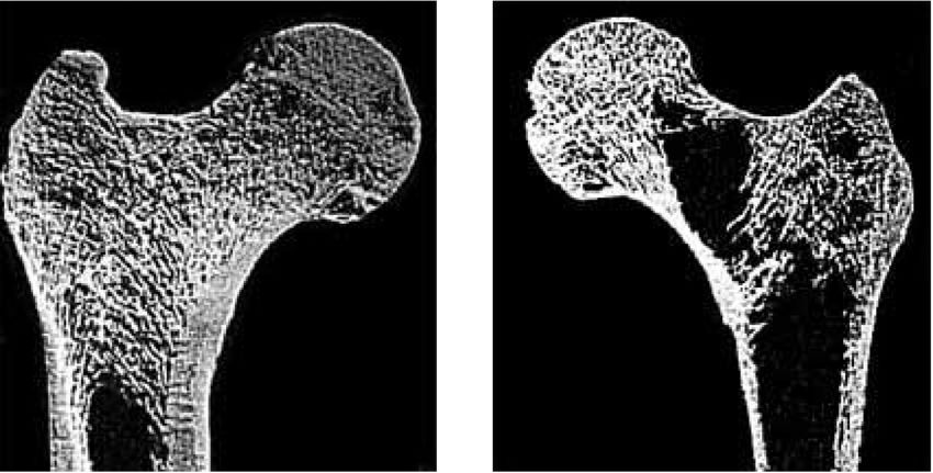 bone degeneration
